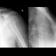 Fracture of colum chirurgicum of humerus: X-ray - Plain radiograph